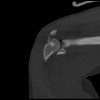SPORK, NICO - 22.03.1976 - 02.08.2022 - CT obere Extremität - 17:59:07